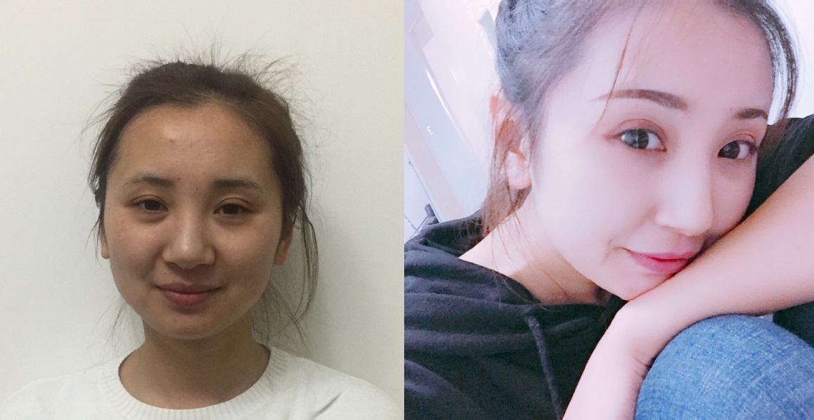 貴陽藝齡醫(yī)療美容門診部醫(yī)生李章做隆鼻手術怎么樣？附案例效果對比圖