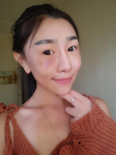 貴陽(yáng)泰康樂(lè)醫(yī)院整形美容科醫(yī)生陳璐做自體脂肪全臉填充效果怎么樣？