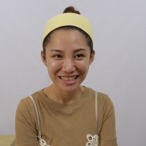 保定東陽口腔醫(yī)院醫(yī)生白小青做牙齒冷光美白怎么樣？附案例效果對比圖