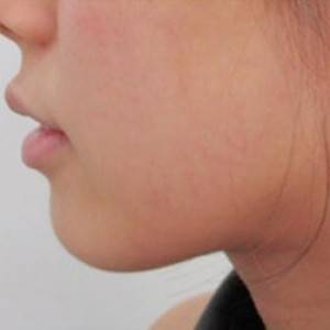 蚌埠韓美美萊整形醫(yī)院醫(yī)生張濤做玻尿酸墊下巴怎么樣？來看案例效果圖