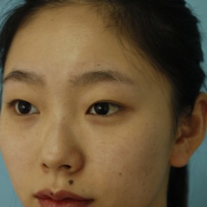 鄭州安格潤整形醫(yī)生楊曉紅做雙眼皮手術(shù)怎么樣？附案例效果圖