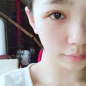 鄭州安格潤整形醫(yī)生楊曉紅做雙眼皮手術(shù)怎么樣？附案例效果圖