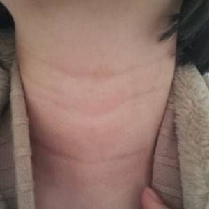 昭通愛麗諾整形醫(yī)生陳志江做嗨體去頸紋怎么樣？附案例效果圖