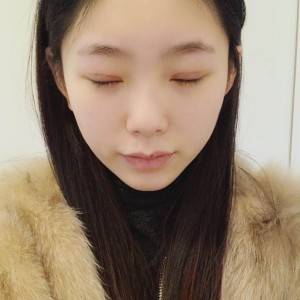 鄭州安格潤整形醫(yī)生楊曉紅做雙眼皮手術(shù)怎么樣？附案例效果圖