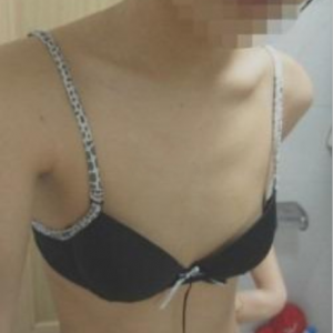 三亞圣迪亞整形美容醫(yī)院醫(yī)生韓超做假體隆胸怎么樣？附案例效果對比圖