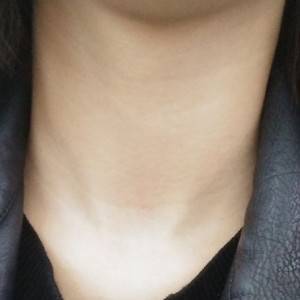 昭通愛麗諾整形醫(yī)生陳志江做嗨體去頸紋怎么樣？附案例效果圖