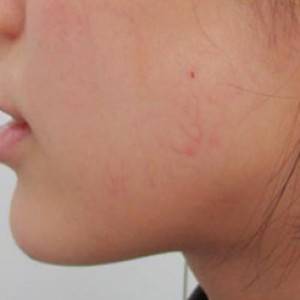 蚌埠韓美美萊整形醫(yī)院醫(yī)生張濤做玻尿酸墊下巴怎么樣？來看案例效果圖