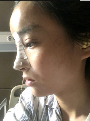 武漢米蘭醫(yī)療美容醫(yī)生柳再億做眼綜合+鼻綜合整形怎么樣？附真實案例對比圖