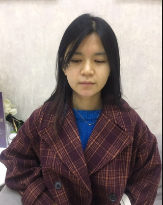 上海時光整形外科醫(yī)院醫(yī)生何晉龍做假體隆胸怎么樣？附案例效果對比圖