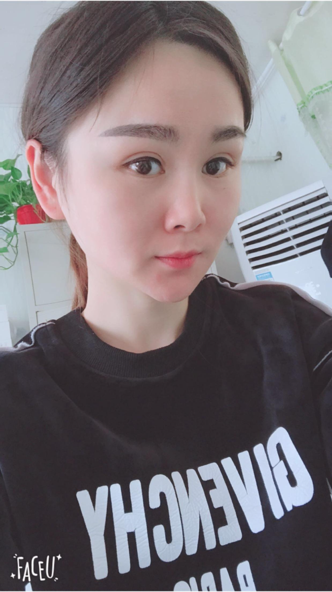 北京彤美美容整形醫(yī)院醫(yī)生楊曉惠做顴骨內(nèi)推+面部吸脂手術(shù)效果怎么樣？附案例