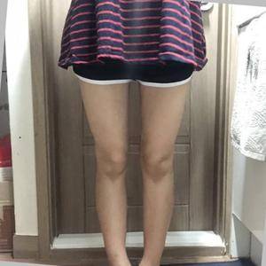 貴陽(yáng)華美整形美容醫(yī)院醫(yī)生田永華做大腿吸脂效果怎么樣？附大腿吸脂案例前后對(duì)比圖