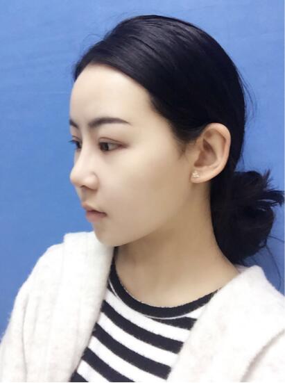 上海時光整形外科醫(yī)院醫(yī)生李靜林做假體隆鼻和反頜手術(shù)怎么樣？