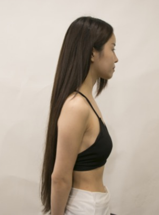 吉林現(xiàn)代整形美容醫(yī)院做假體隆胸效果怎么樣？附醫(yī)院案例效果對比圖