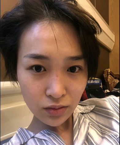 武漢米蘭醫(yī)療美容醫(yī)生柳再億做眼綜合+鼻綜合整形怎么樣？附真實案例對比圖