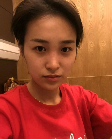 武漢米蘭醫(yī)療美容醫(yī)生柳再億做眼綜合+鼻綜合整形怎么樣？附真實案例對比圖