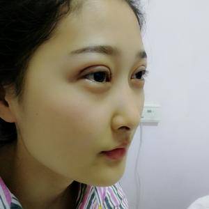 周口垣夢(mèng)醫(yī)療整形醫(yī)生王濤做切開(kāi)雙眼皮怎么樣？附切開(kāi)雙眼皮案例效果對(duì)比圖