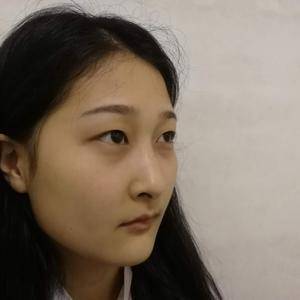 周口垣夢(mèng)醫(yī)療整形醫(yī)生王濤做切開(kāi)雙眼皮怎么樣？附切開(kāi)雙眼皮案例效果對(duì)比圖