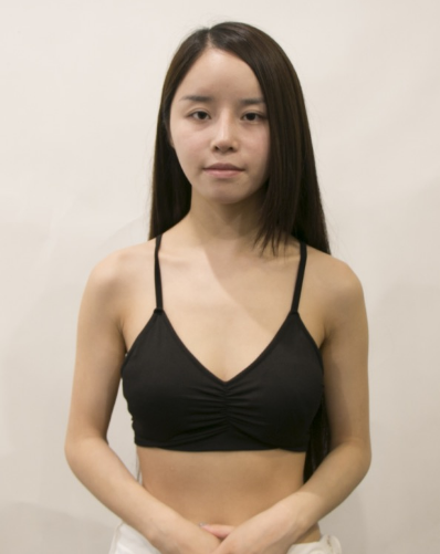 吉林現(xiàn)代整形美容醫(yī)院做假體隆胸效果怎么樣？附醫(yī)院案例效果對比圖