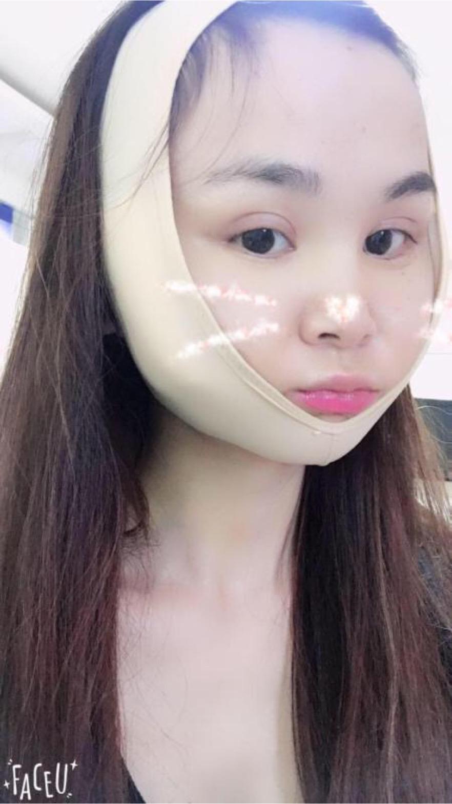 北京彤美美容整形醫(yī)院醫(yī)生楊曉惠做顴骨內(nèi)推+面部吸脂手術(shù)效果怎么樣？附案例