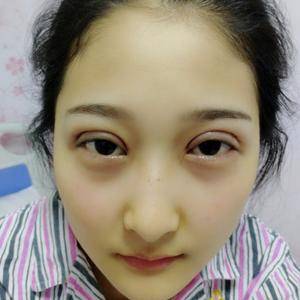 周口垣夢(mèng)醫(yī)療整形醫(yī)生王濤做切開(kāi)雙眼皮怎么樣？附切開(kāi)雙眼皮案例效果對(duì)比圖
