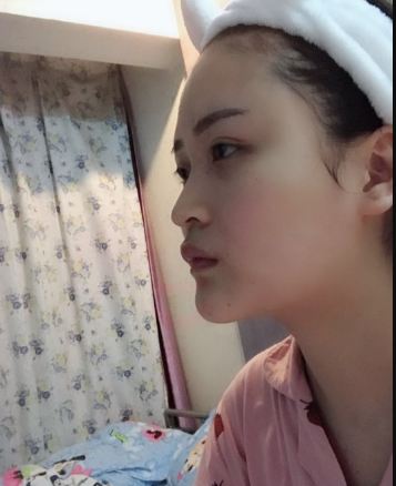北京伊美爾美容愛康醫(yī)院醫(yī)生柳成做鼻綜合整形怎么樣？附案例效果圖