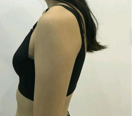 武漢伽美醫(yī)療美容醫(yī)院醫(yī)生朱富初做自體脂肪隆胸怎么樣？看案例