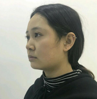 上海時光整形醫(yī)院做豐下巴怎么樣？許黎平醫(yī)生豐下巴案例分享