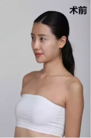 上海時(shí)光整形醫(yī)院何晉龍醫(yī)生做假體隆胸怎么樣？附案例對(duì)比圖