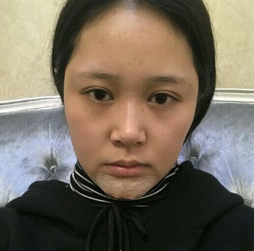 上海時(shí)光整形醫(yī)院做豐下巴怎么樣？許黎平醫(yī)生豐下巴案例分享