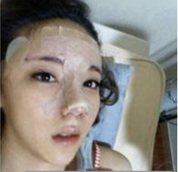 上海時(shí)光整形醫(yī)生何晉龍做假體隆鼻效果怎么樣？附案例效果對(duì)比圖