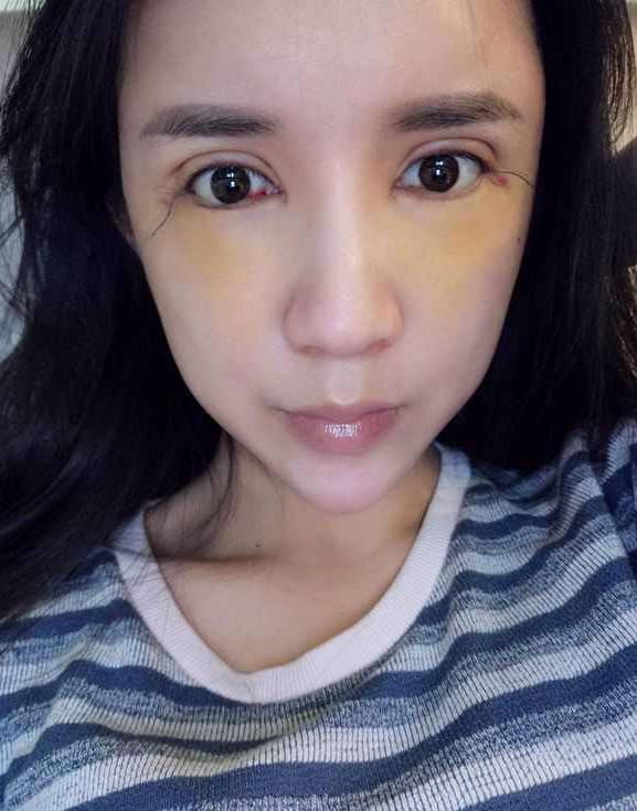 上海時(shí)光整形醫(yī)院張晶醫(yī)生做開眼角怎么樣？附真實(shí)效果圖