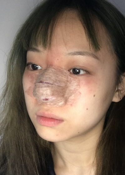 蚌埠韓美美萊整形做手術(shù)縮鼻頭效果怎么樣？附周娜醫(yī)生縮鼻頭案例效果圖