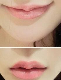 巴中時(shí)光醫(yī)學(xué)美容門診部做玻尿酸豐唇效果怎么樣？附李紅強(qiáng)豐唇案例