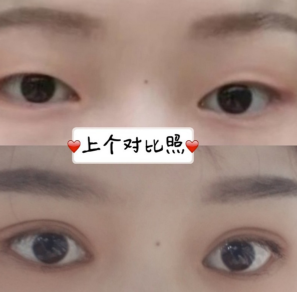 鞍山菲之都醫(yī)療整形醫(yī)院做開眼角+全切雙眼皮效果怎么樣？附藺嬌婷醫(yī)生案例