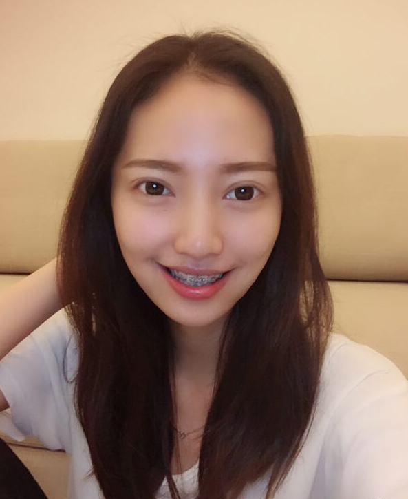 巴中華醫(yī)口腔醫(yī)院做牙齒矯正效果好嗎？附母汶靈醫(yī)生牙齒矯正案例效果圖