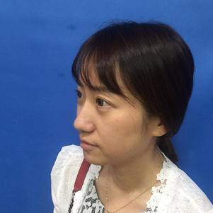 蚌埠韓美美萊整形做玻尿酸面部除皺效果怎么樣？附陳澤醫(yī)生案例效果圖