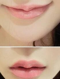巴中時光醫(yī)學美容門診部做玻尿酸豐唇效果怎么樣？附李紅強豐唇案例