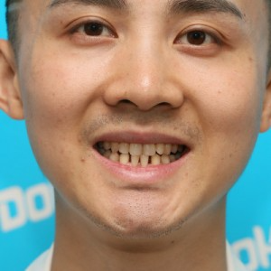 鞍山時(shí)代口腔門診部做瓷貼面怎么樣？附孫興國醫(yī)生瓷貼面案例效果圖