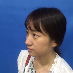 蚌埠韓美美萊整形做玻尿酸面部除皺效果怎么樣？附陳澤醫(yī)生案例效果圖