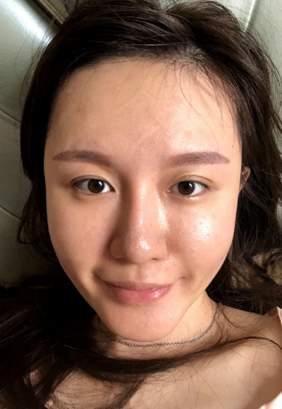 蚌埠韓美美萊整形醫(yī)生張燕做自體脂肪豐面頰效果怎么樣？附案例效果圖