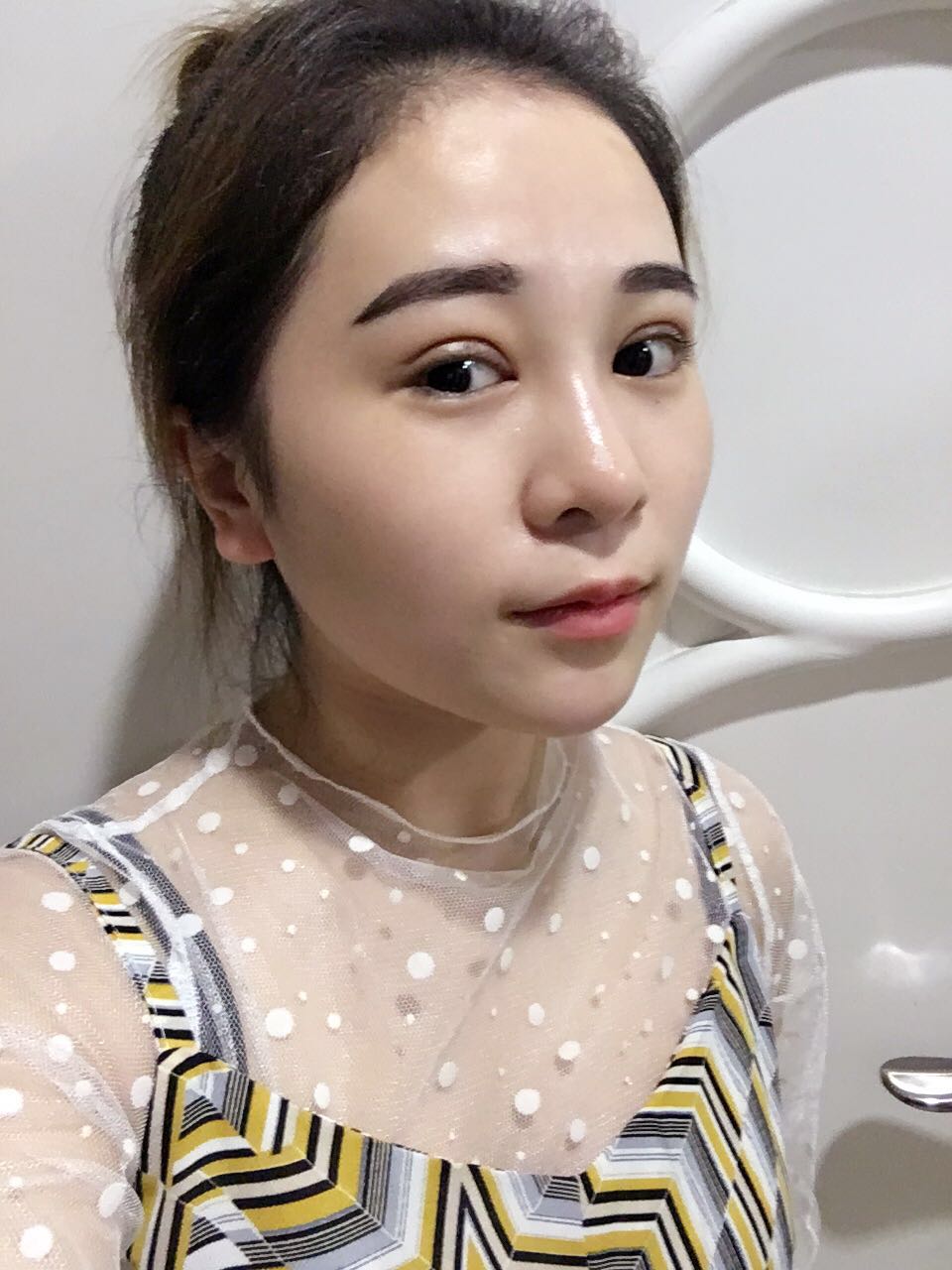 蚌埠韓美美萊整形醫(yī)生鄭捷做開眼角怎么樣？附案例效果圖
