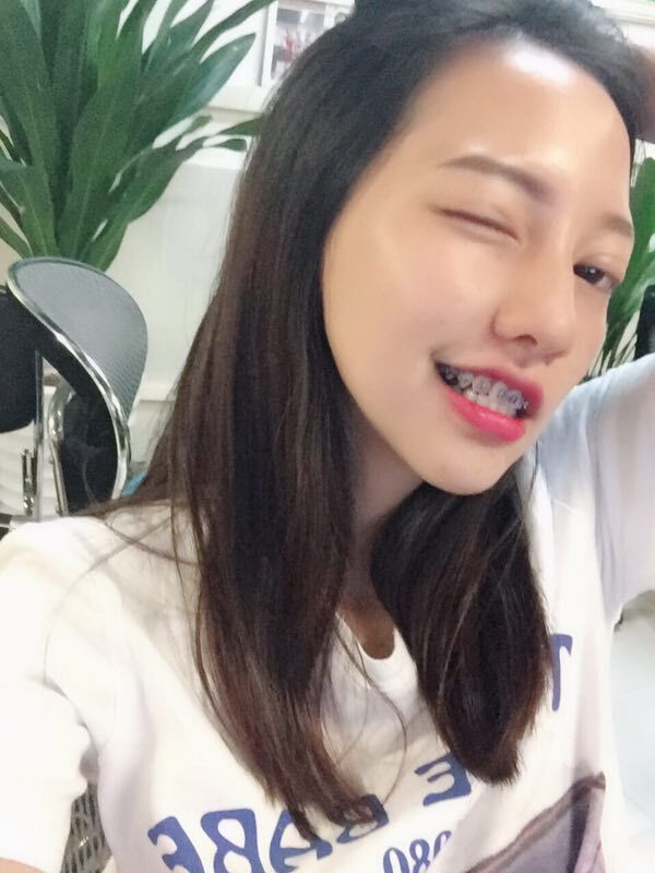巴中華醫(yī)口腔醫(yī)院做牙齒矯正效果好嗎？附母汶靈醫(yī)生牙齒矯正案例效果圖