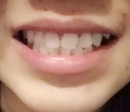 鞍山時(shí)代口腔門診部劉昕醫(yī)生做美容冠效果怎么樣？一起來(lái)看看吧