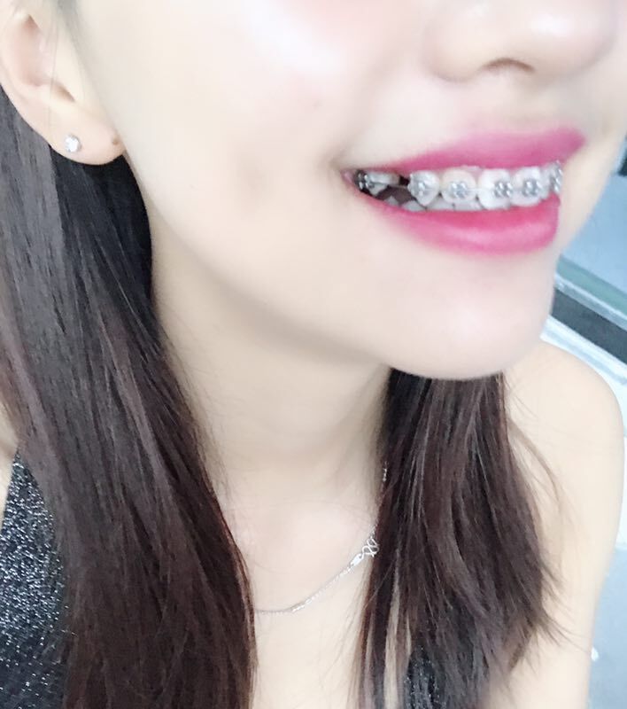 巴中華醫(yī)口腔醫(yī)院做牙齒矯正效果好嗎？附母汶靈醫(yī)生牙齒矯正案例效果圖