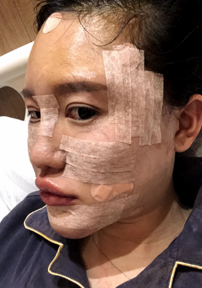 蚌埠韓美美萊整形醫(yī)生張燕做自體脂肪豐面頰效果怎么樣？附案例效果圖