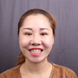 保定東陽口腔醫(yī)院趙晨醫(yī)生做瓷貼面怎么樣？附瓷貼面案例效果對比圖