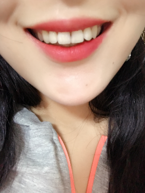 保定東陽(yáng)口腔醫(yī)院白小青醫(yī)生做牙齒矯正怎么樣?附牙齒矯正案例效果對(duì)比圖
