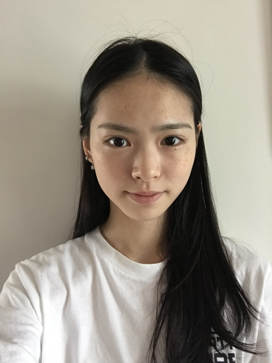 保定市第五醫(yī)院美容整形科做激光祛斑怎么樣？附單敬依醫(yī)生案例效果圖
