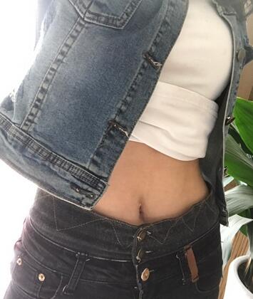 保定現(xiàn)代女子醫(yī)院整形美容中心做腰腹部吸脂怎么樣？附林秀蓮醫(yī)生案例效果圖