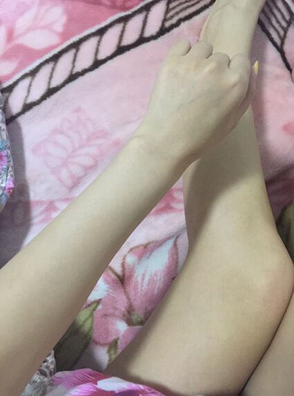 蚌埠市第三人民醫(yī)院燒傷整形科李方奇注射美白針效果怎么樣？安全嗎？附案例